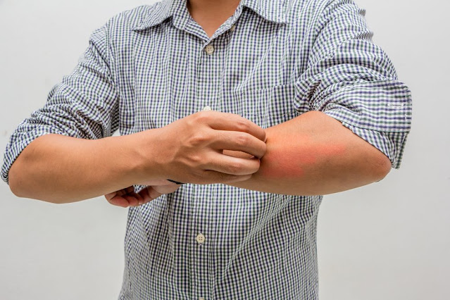 How to relieve itchy skin and to Treat Naturally