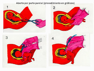 Resultado de imagen para ABORTO POR PARTO INCOMPLETO