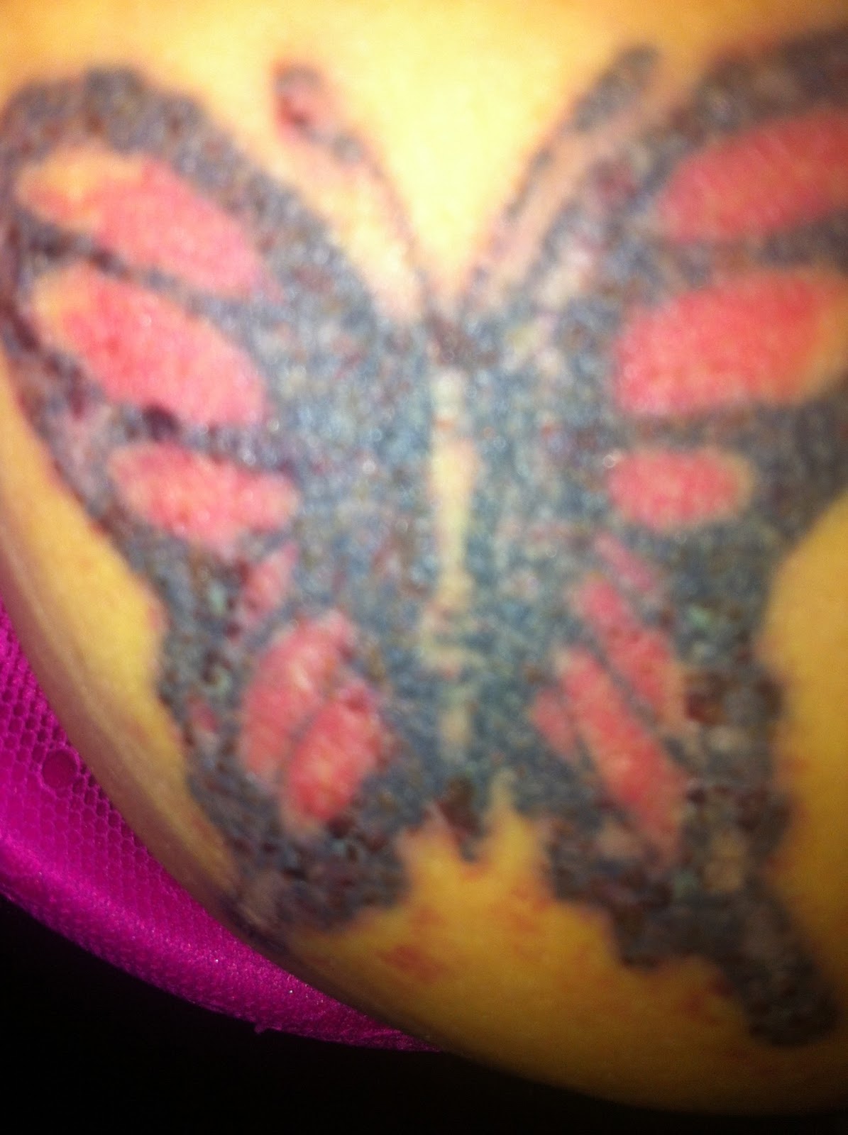 Jessiicake: Tattoo Removal