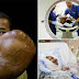     Man who had  tumour twice the size of his head removed after walking 3 days for help