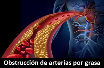 Obstrucción de arterias por grasa
