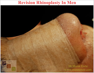 Revision Nose Job Surgery for Men - Revision Male Rhinoplasty - Men's Revision Rhinoplasty - Revision Nose Reshaping for Men - Mens Revision Rhinoplasty - Revision Nose Job Rhinoplasty for Men - Best Revision Rhinoplasty For Men Istanbul - Revision Nose Aesthetic for Men - Male Revision Nose Operation - Male Revision Rhinoplasty Surgery in Istanbul - Male Revision Rhinoplasty Surgery in Turkey - Male Revision Nose Aesthetic Surgery - Revision Rhinoplasty In Mens