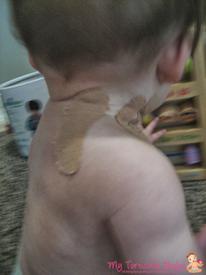 A baby with kinesio tape on her neck to help treat her torticollis