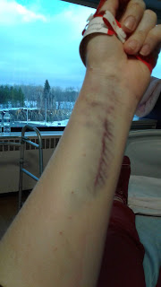My very bruised right arm, 10 poke holes and a strange pattern of echymosis where they failed to start an arterial line