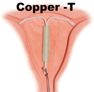 Learn about the use of copper-T, its advantages