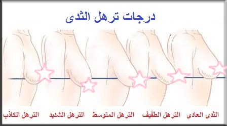 أسباب و درجات ترهل الثدي