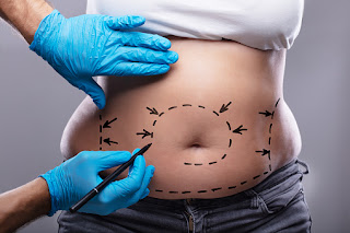 Liposuction (Yağ Aldırma) Nedir? Nasıl Uygulanır? Liposuction İle İlgili Tüm Bilmeniz Gerekenler