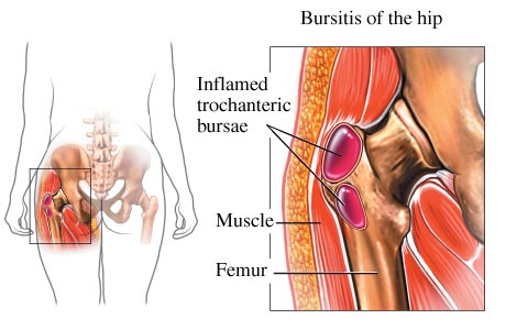 Hip_Bursitis.jpg (460×300)