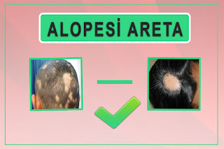 Alopesi Areata