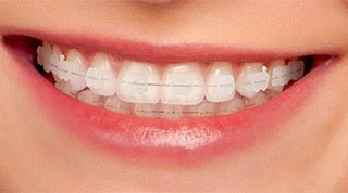 Tìm hiểu về niềng răng mắc cài sứ-1