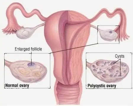 Please know about of ovarian disease?