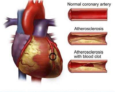 Atherosclerosis Illustration blood clot angina pectoris