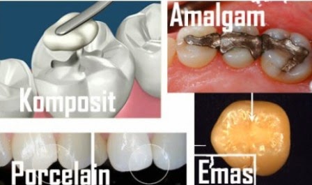 Biaya Tambal  Gigi  Berlubang dan Jenis Bahannya Dokter Gigi 