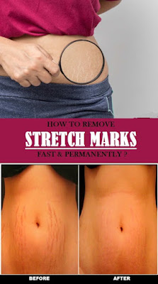 Sretch-marks-removal