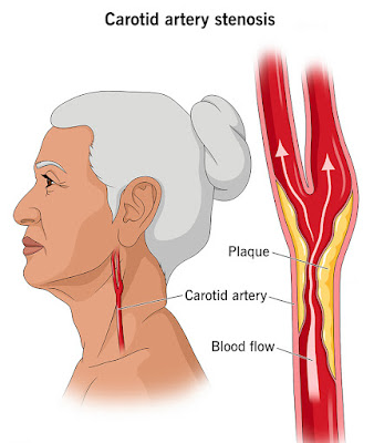 Carotid Artery Disease