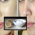 Treat Pimple Quickly: 10 Best Simple Treatments You Can Do At Home