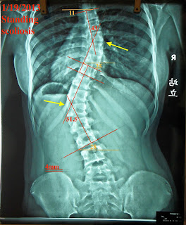 脊椎側彎, 脊椎側彎背架, 脊椎度數,脊椎側彎矯正, 脊椎側彎治療, schroth運動, schroth脊椎側彎, 德國Schroth