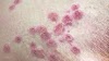  Is Monkeypox Dangerous? Everything You Need To Know