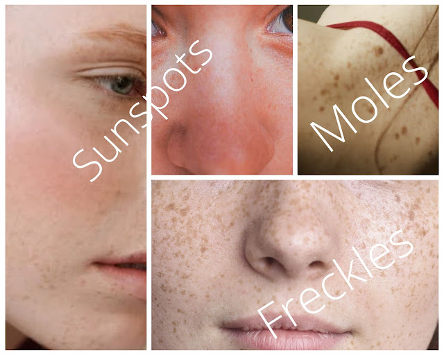 What are freckles caused by
