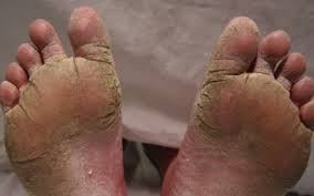 obat eksim menahun pada kaki obat eksim menahun pada kaki