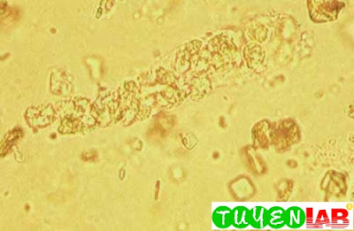 WBC cast and uric acid crystals. Same patient as in previous ﬁgure (400x)