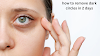 how to remove dark circles in 2 days