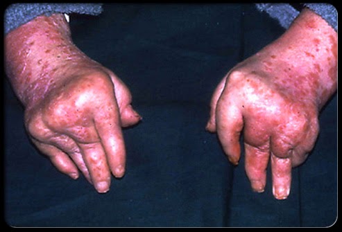 Testimoni Penghidap Psoriasis Arthritis ~ RUMAH SIHAT AN 