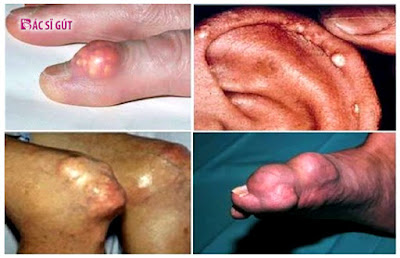 biến chứng nguy hiểm của bệnh gout