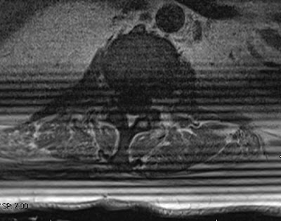 Slice overlying artefacts