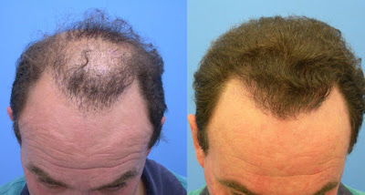 Hair Transplant Clinic in Mumbai