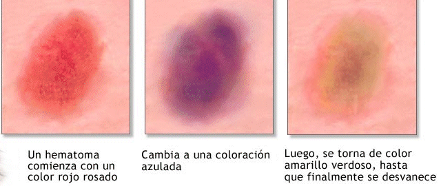 Resultado de imagen de hematoma