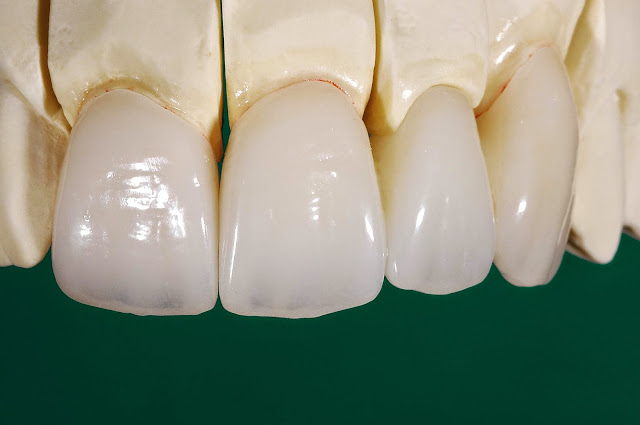 Trong-rang-rang-su-Ceramill-01