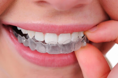Tiến hành niềng răng vẩu hàm dưới cải thiện thẩm mỹ-1