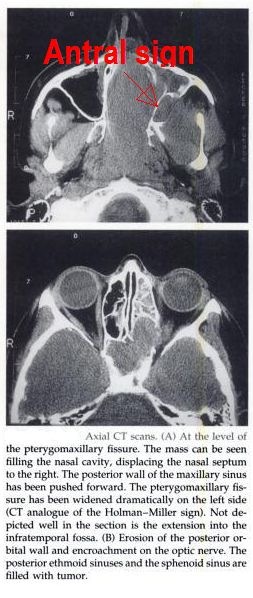 antral sign