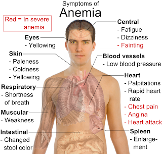 اعراض فقر الدم الانيميا Anemia