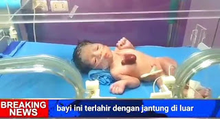 Viral Bayi ini Terlahir Dengan Jantung Berada Di Luar