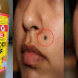 How To Remove Moles Without Pain Naturally - See Remedy!