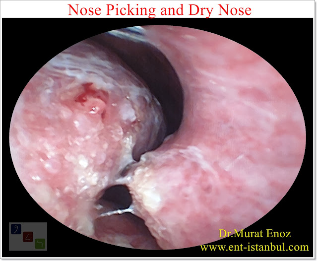 Nose Picking and Dry Nose, Nasal Dryness