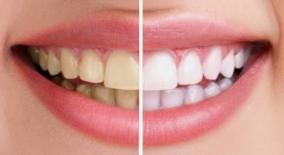 Tẩy trắng răng có hại không-3