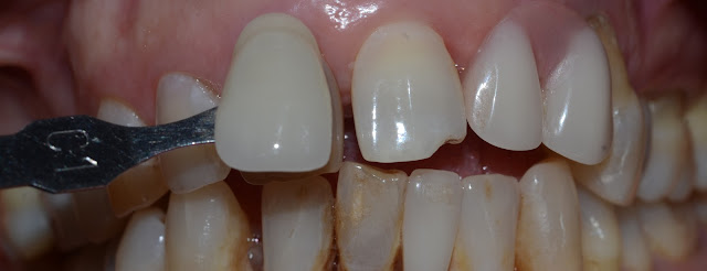 Shade Matching with Adjacent Teeth