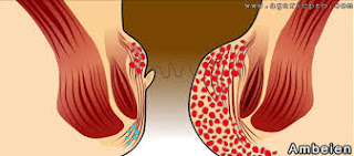 Penyakit Ambeien dan Cara Mengatasinya