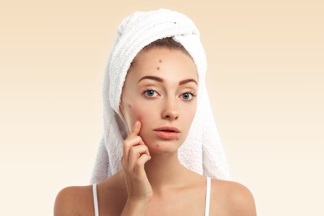 4 Easy Remedies For Getting Rid Of Acne