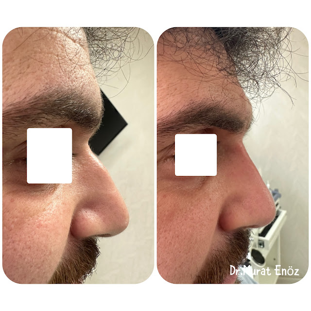 None Surgical Reshaping of The Nose