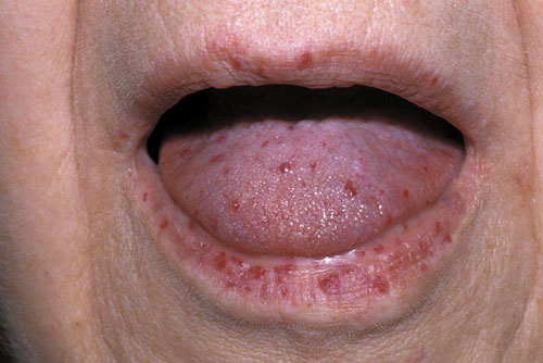 Hereditary hemorrhagic telangiectasia (Osler-Weber-Rendu syndrome) is an autosomal dominant disorder that manifests with widespread cutaneous, mucosal, and visceral telangiectases and arteriovenous malformations. Papular, punctate, and linear telangiectases occur predominantly on the tongue, lips, digit tips, perioral region, and trunk.