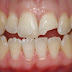 Những trường hợp nào nên bọc răng sứ?
