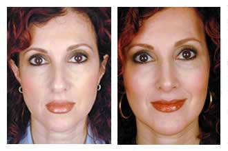 Rhinoplasty Pictures