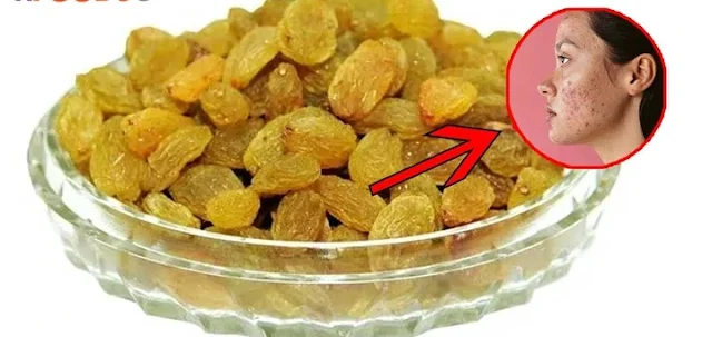 How to Remove Acne By Using Raisins Water: Homemade Glow Skin Secret