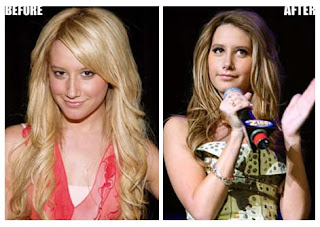 Ashley Tisdale Plastic Surgery