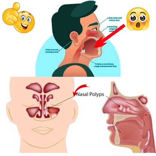 Top 10 are  prescriptions that will cure your nasal congestion. Can prevent cough and sneezing.