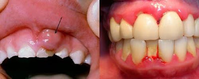 Điều trị nướu sưng có mủ và cách bảo vệ răng miệng tốt nhất-1